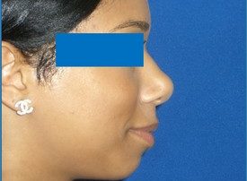 NOSE SURGERY – RHINOPLASTY