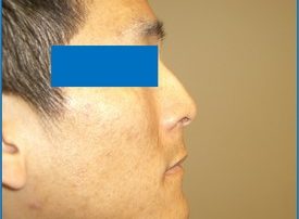 NOSE SURGERY – RHINOPLASTY