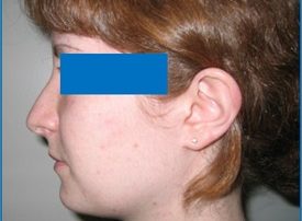 NOSE SURGERY – RHINOPLASTY