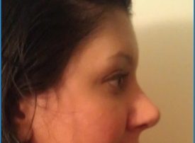 NOSE SURGERY – RHINOPLASTY