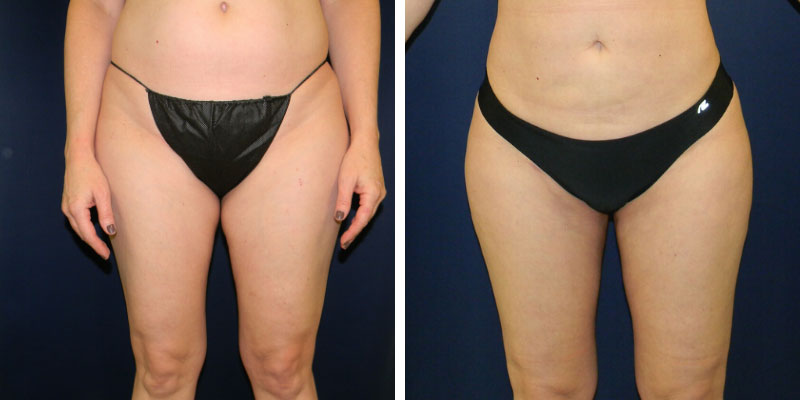 LIPOSUCTION/LASER LIPO/SMART LIPO