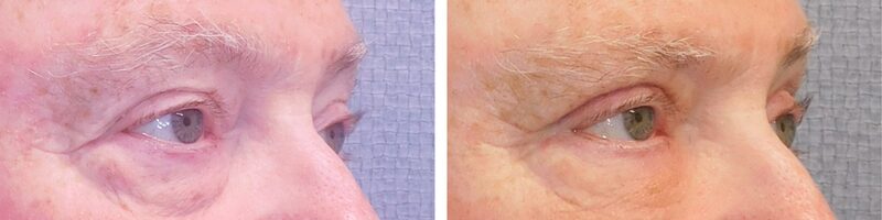Washingtonian Eyelid Surgery Patient 4899 (2)