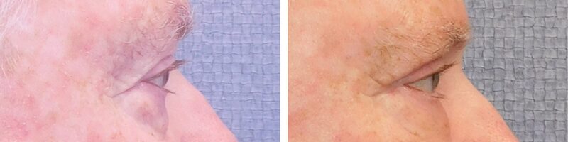 Washingtonian Eyelid Surgery Patient 4899 (3)