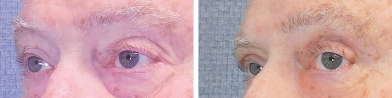 Washingtonian Eyelid Surgery Patient 4899 (4)