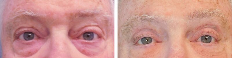 Washingtonian Eyelid Surgery Patient 4899 (5)