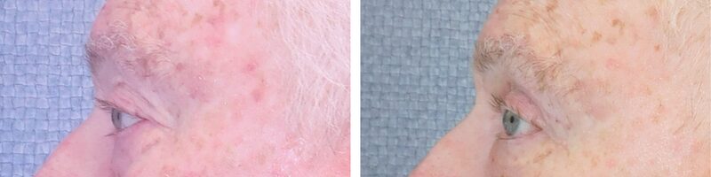Washingtonian Eyelid Surgery Patient 4899