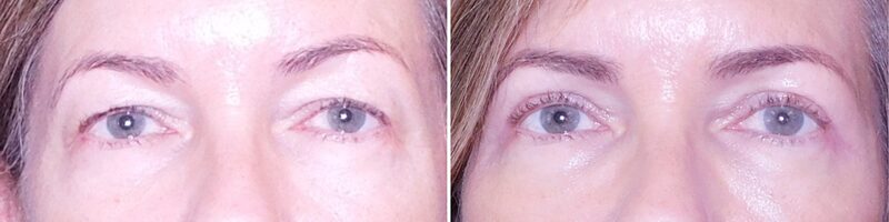 Washingtonian Eyelid Surgery Patient 5941